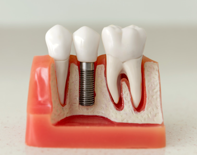 Love your smile again with dental implants in Lilburn! Brilliance Family Dental offers All-on-4 & single implants. Permanent, natural results!